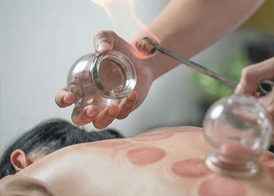Half-body Cupping